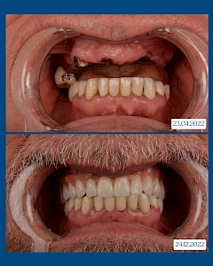 Maxillary full-arch rehabilitation featuring 6 Osstem implants supporting a Toronto framework with zirconium crowns. This prosthetic solution aims for functional rehabilitation by enhancing biomechanical resistance and ensuring balanced distribution of occlusal forces.